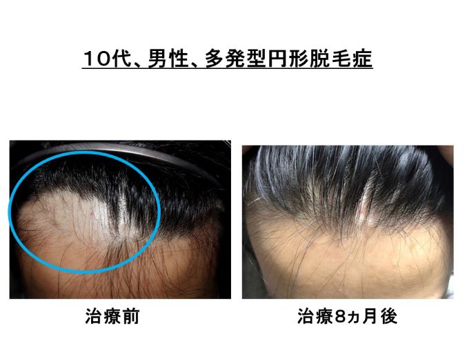 円形脱毛症　病院